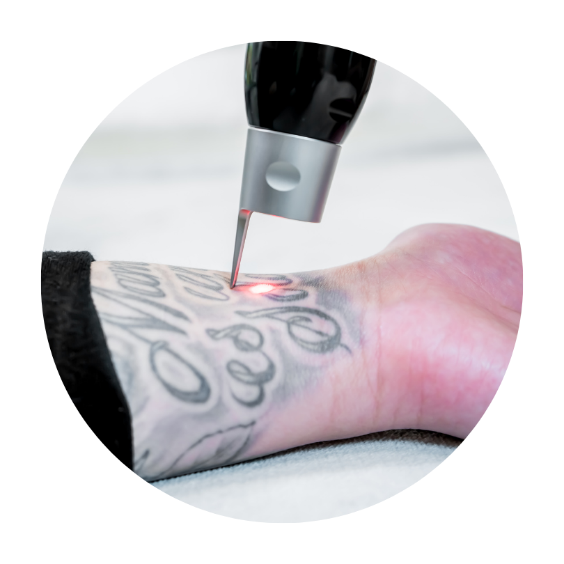 Picosecond laser pigmentation removal tattoo removal machine